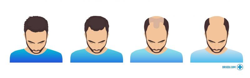 informerande bild om håravfall. fyra stadier av manligt håravfall, från mild håravfall till skallighet.