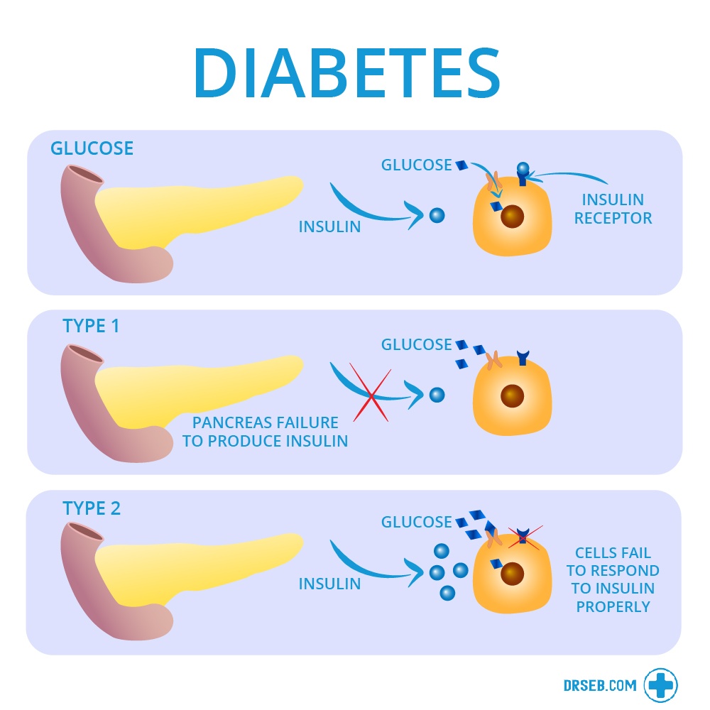 What is diabetes? 
