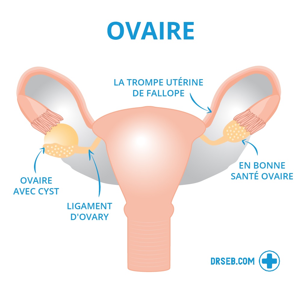 Syndrome des ovaire polykystiques (SOPK) : Symptômes, douleurs et ...